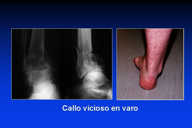 Callo vicioso en varo 