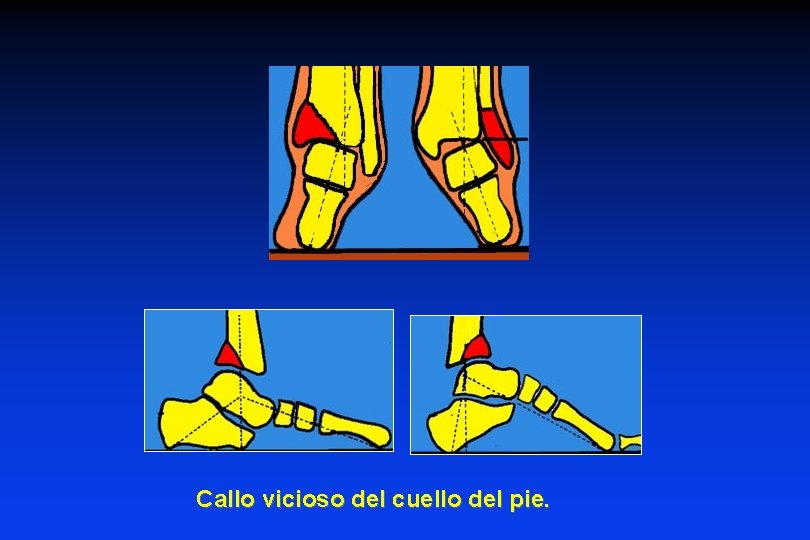Callo vicioso del cuello del pie. Callo vicioso del cuello del pie.