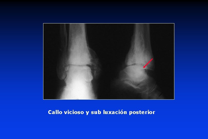 Callo vicioso y sub luxación posterior 