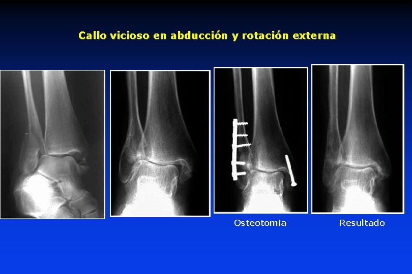 Callo vicioso en abducción y rotación externa Osteotomía Resultado 