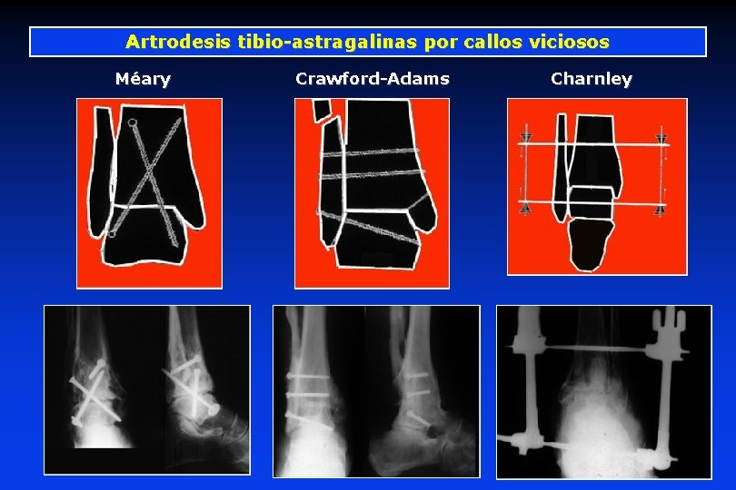 Artrodesis tibio-astragalinas por callos viciosos Méary Crawford-Adams Charnley Artrodesis tibio-astragalinas por callos viciosos Méary Crawford-Adams Charnley
