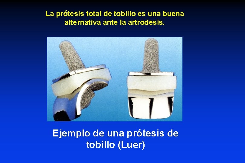 La prótesis total de tobillo es una buena alternativa ante la artrodesis. Ejemplo de La prótesis total de tobillo es una buena alternativa ante la artrodesis. Ejemplo de