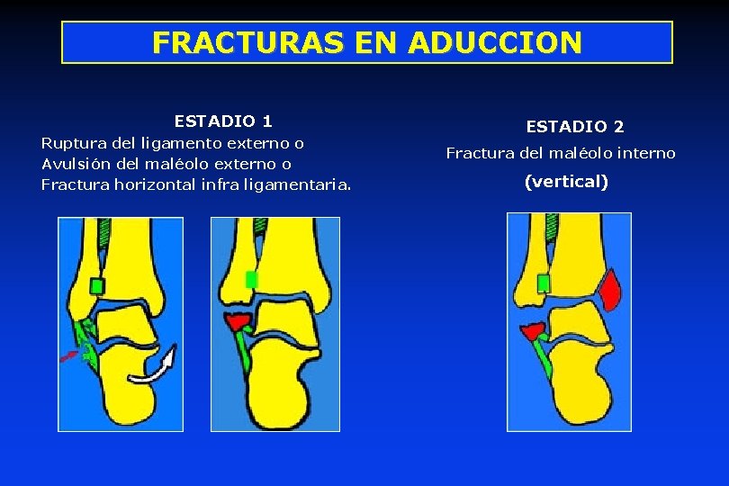 FRACTURAS EN ADUCCION ESTADIO 1 Ruptura del ligamento externo o Avulsión del maléolo externo