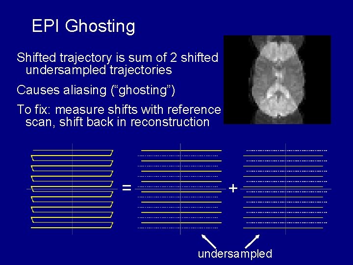 EPI Ghosting Shifted trajectory is sum of 2 shifted undersampled trajectories Causes aliasing (“ghosting”)