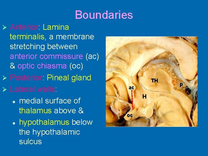 Boundaries Anterior: Lamina terminalis, a membrane stretching between anterior commissure (ac) & optic chiasma