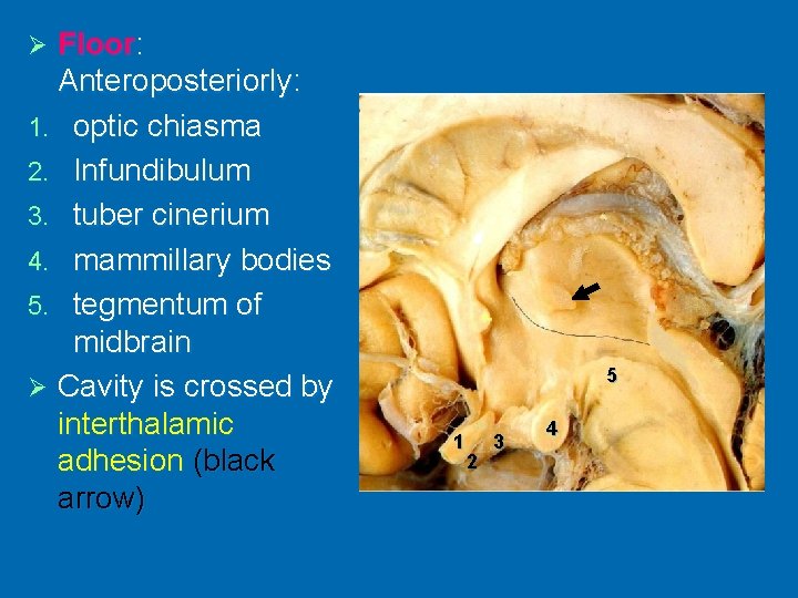 Floor: Anteroposteriorly: 1. optic chiasma 2. Infundibulum 3. tuber cinerium 4. mammillary bodies 5.