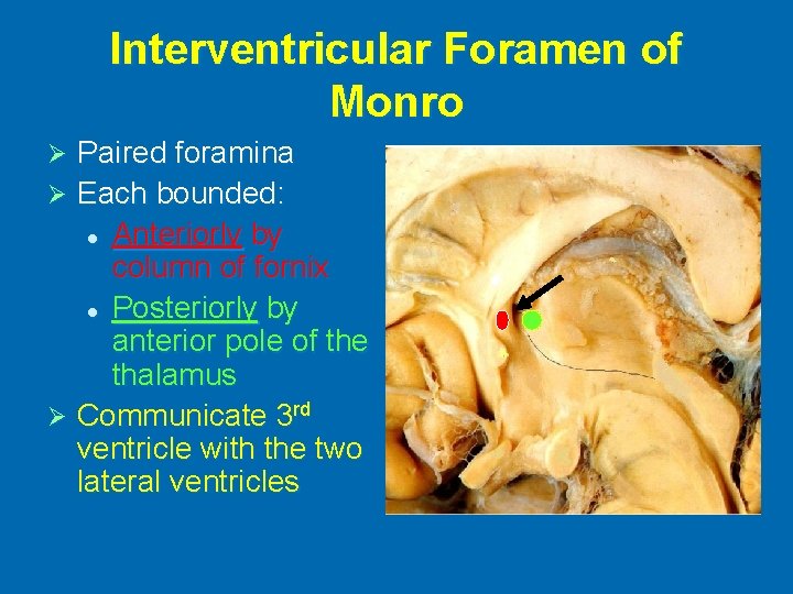 Interventricular Foramen of Monro Paired foramina Ø Each bounded: l Anteriorly by column of