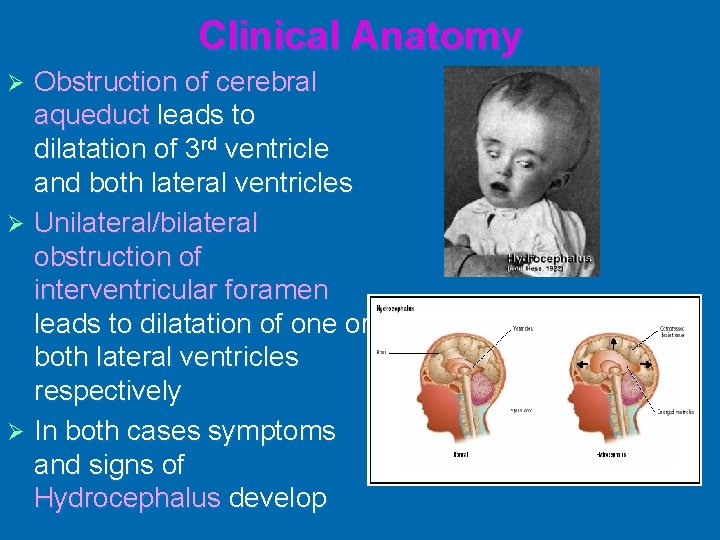 Clinical Anatomy Obstruction of cerebral aqueduct leads to dilatation of 3 rd ventricle and