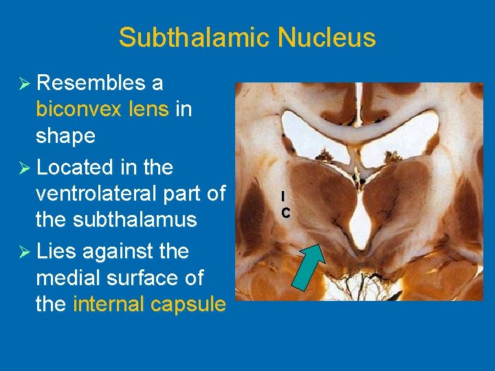 Subthalamic Nucleus Ø Resembles a biconvex lens in shape Ø Located in the ventrolateral
