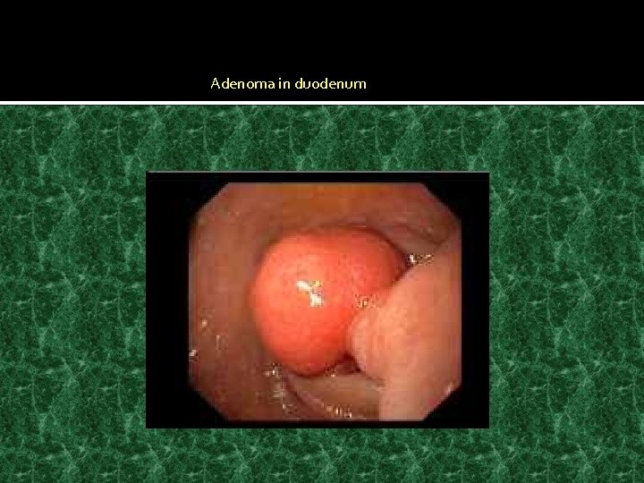 Adenoma in duodenum 