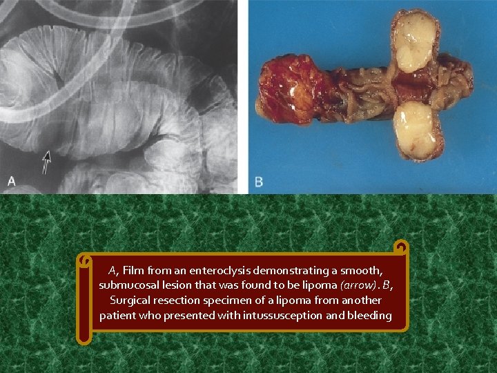 A, Film from an enteroclysis demonstrating a smooth, submucosal lesion that was found to