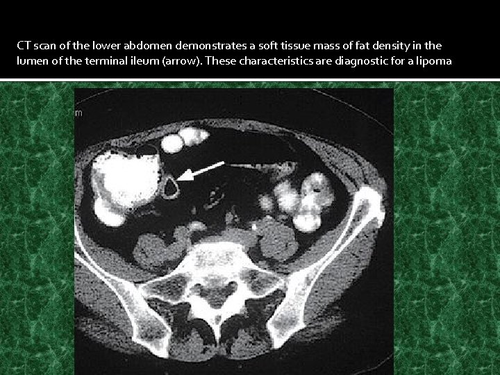 CT scan of the lower abdomen demonstrates a soft tissue mass of fat density