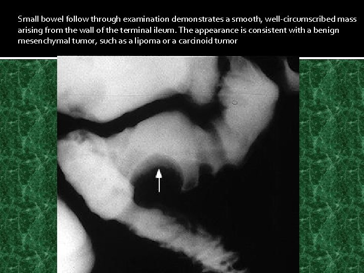 Small bowel follow through examination demonstrates a smooth, well-circumscribed mass arising from the wall