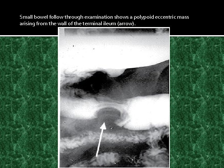 Small bowel follow through examination shows a polypoid eccentric mass arising from the wall