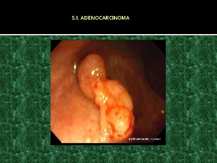 S. I. ADENOCARCINOMA 