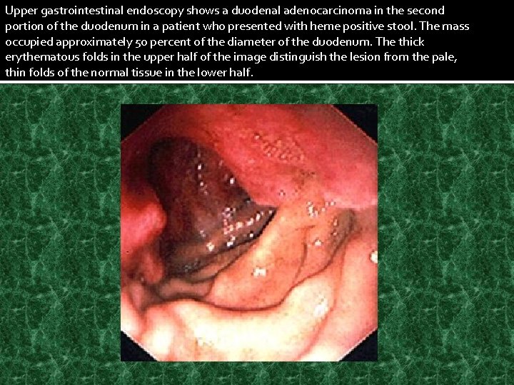 Upper gastrointestinal endoscopy shows a duodenal adenocarcinoma in the second portion of the duodenum