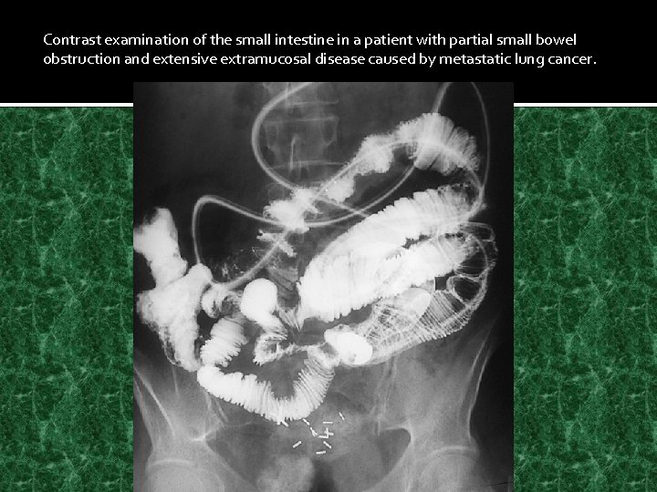 Contrast examination of the small intestine in a patient with partial small bowel obstruction
