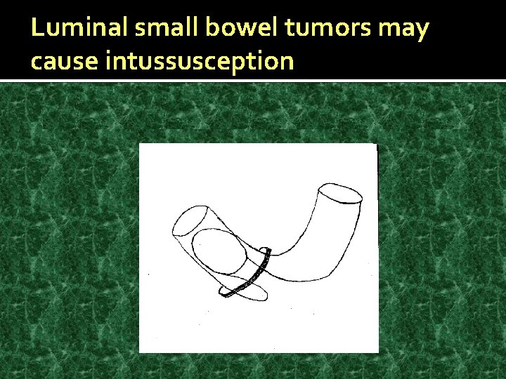 Luminal small bowel tumors may cause intussusception 