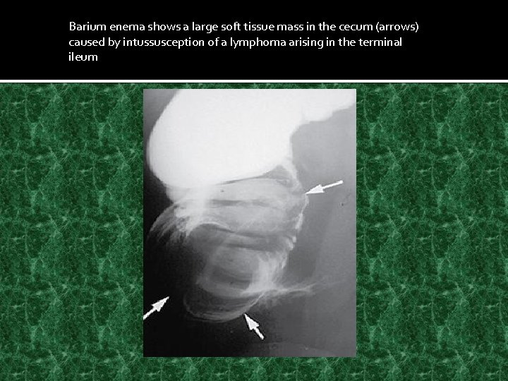 Barium enema shows a large soft tissue mass in the cecum (arrows) caused by
