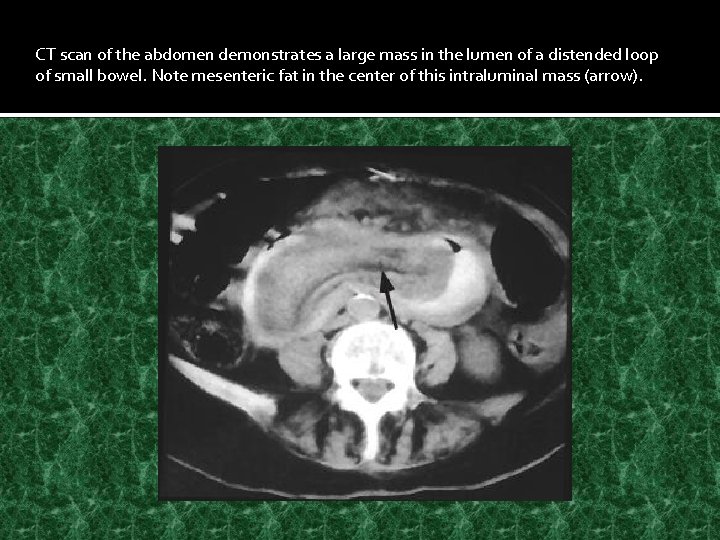 CT scan of the abdomen demonstrates a large mass in the lumen of a