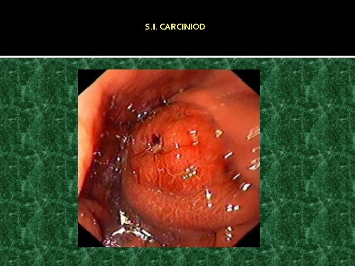 S. I. CARCINIOD 