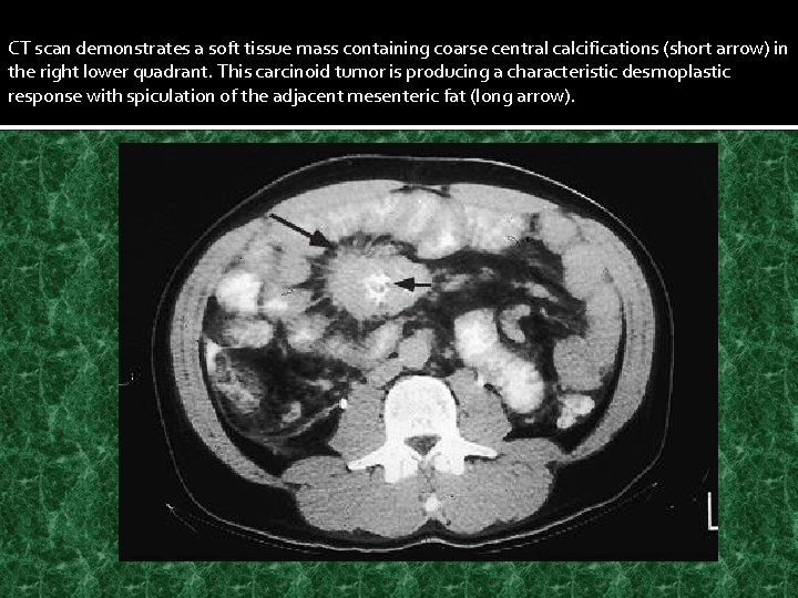 CT scan demonstrates a soft tissue mass containing coarse central calcifications (short arrow) in