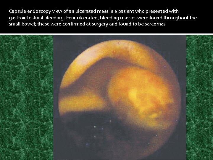 Capsule endoscopy view of an ulcerated mass in a patient who presented with gastrointestinal