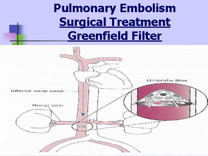 Pulmonary Embolism Surgical Treatment Greenfield Filter 