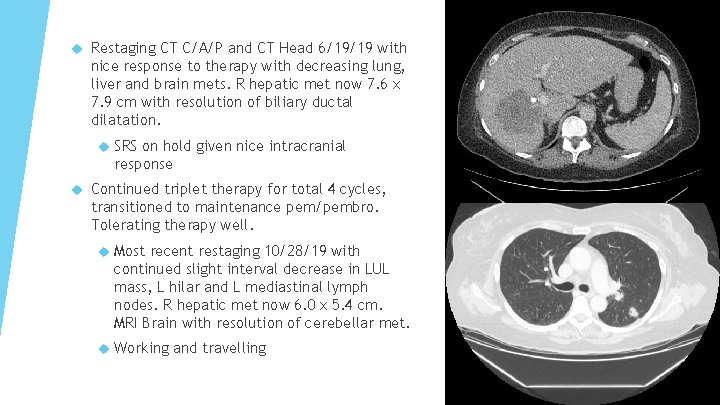  Restaging CT C/A/P and CT Head 6/19/19 with nice response to therapy with