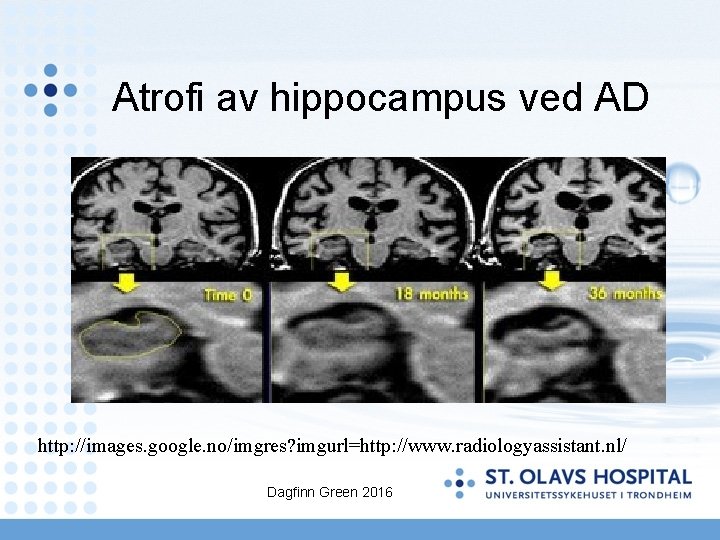 Atrofi av hippocampus ved AD http: //images. google. no/imgres? imgurl=http: //www. radiologyassistant. nl/ Dagfinn
