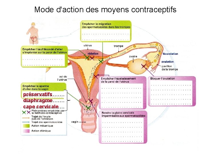 Mode d'action des moyens contraceptifs préservatifs ………… diaphragme ………… cape ………… cervicale 