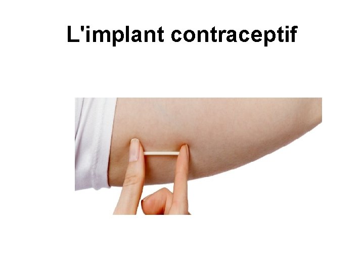 L'implant contraceptif 