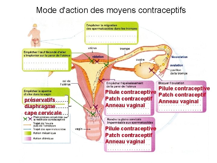 Mode d'action des moyens contraceptifs préservatifs ………… diaphragme ………… cape ………… cervicale Pilule contraceptive