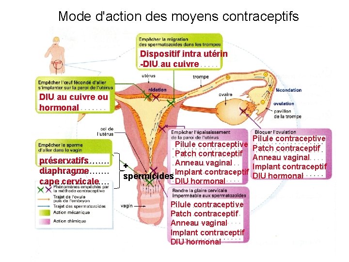 Mode d'action des moyens contraceptifs Dispositif intra utérin -DIU au cuivre ou hormonal préservatifs
