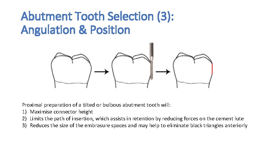 Abutment Tooth Selection (3): Angulation & Position Proximal preparation of a tilted or bulbous