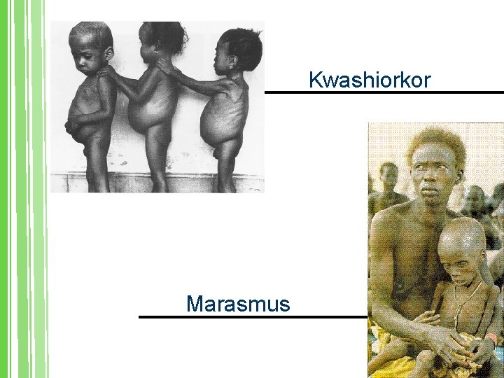 Kwashiorkor Marasmus 