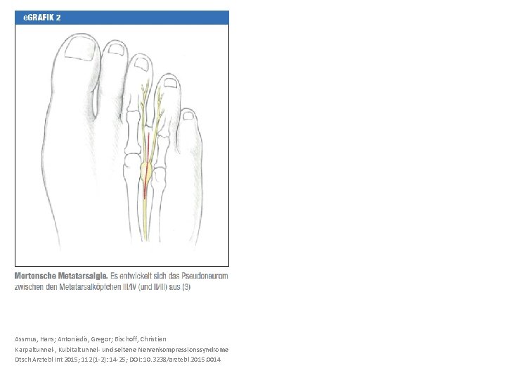 Assmus, Hans; Antoniadis, Gregor; Bischoff, Christian Karpaltunnel-, Kubitaltunnel- und seltene Nervenkompressionssyndrome Dtsch Arztebl Int