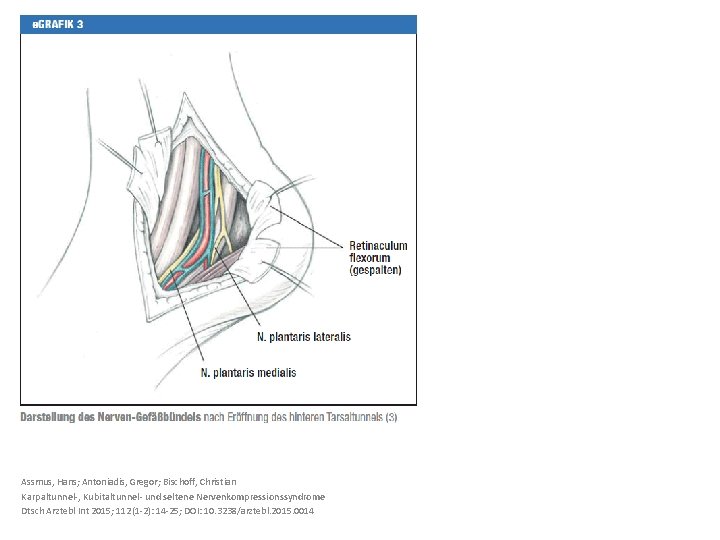 Assmus, Hans; Antoniadis, Gregor; Bischoff, Christian Karpaltunnel-, Kubitaltunnel- und seltene Nervenkompressionssyndrome Dtsch Arztebl Int