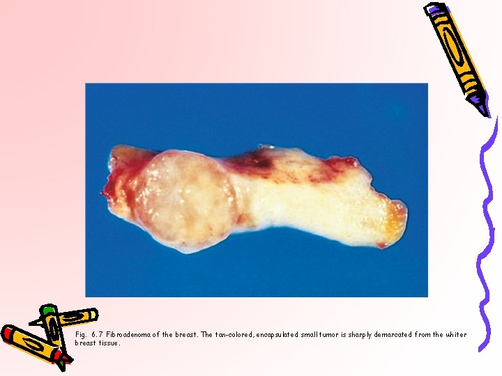 Fig. 6. 7 Fibroadenoma of the breast. The tan-colored, encapsulated small tumor is sharply