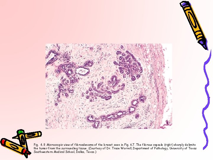 Fig. 6. 8 Microscopic view of fibroadenoma of the breast seen in Fig. 6.