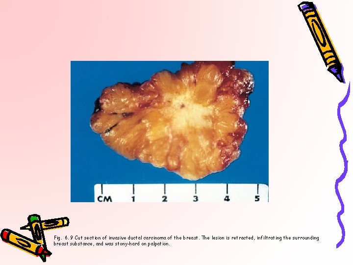 Fig. 6. 9 Cut section of invasive ductal carcinoma of the breast. The lesion