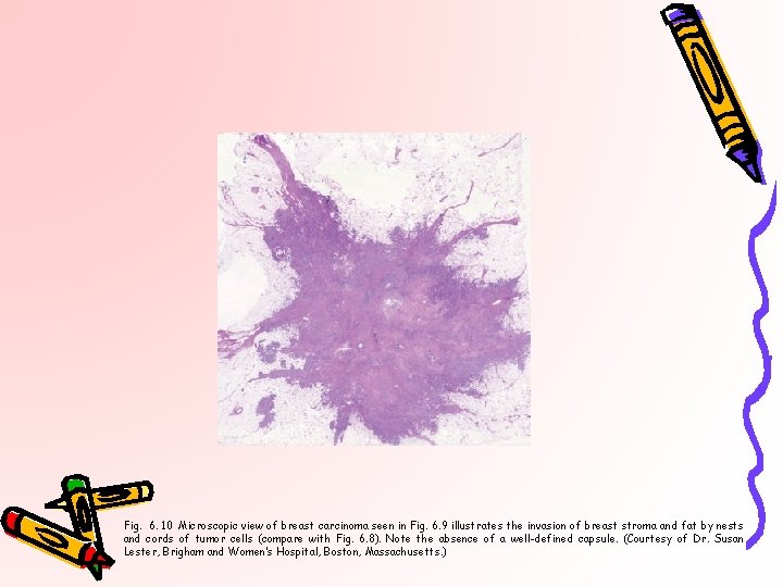 Fig. 6. 10 Microscopic view of breast carcinoma seen in Fig. 6. 9 illustrates