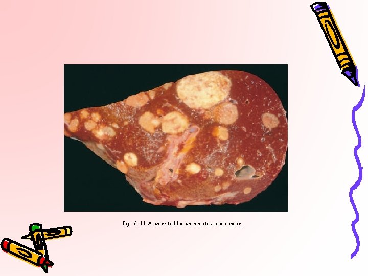 Fig. 6. 11 A liver studded with metastatic cancer. 