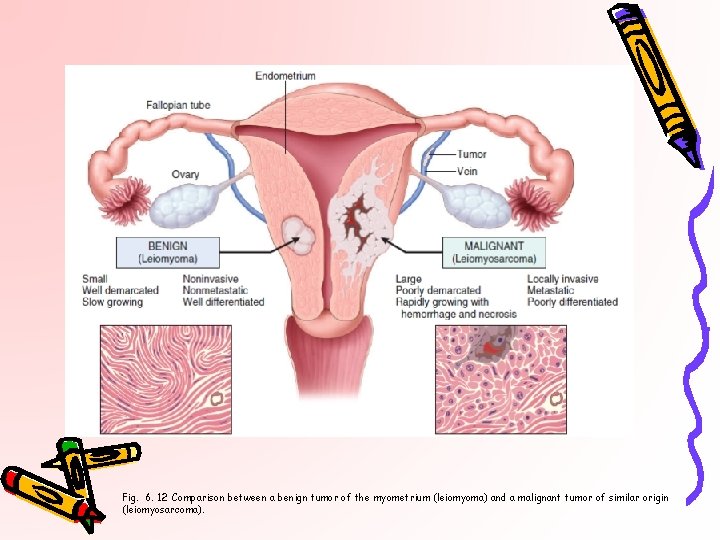 Fig. 6. 12 Comparison between a benign tumor of the myometrium (leiomyoma) and a