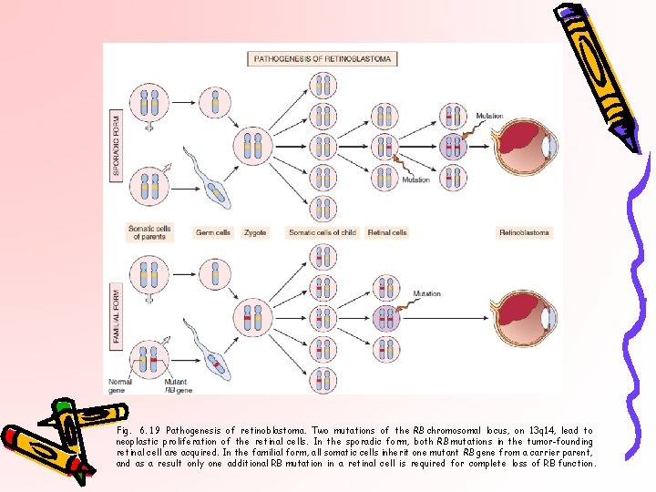 Fig. 6. 19 Pathogenesis of retinoblastoma. Two mutations of the RB chromosomal locus, on