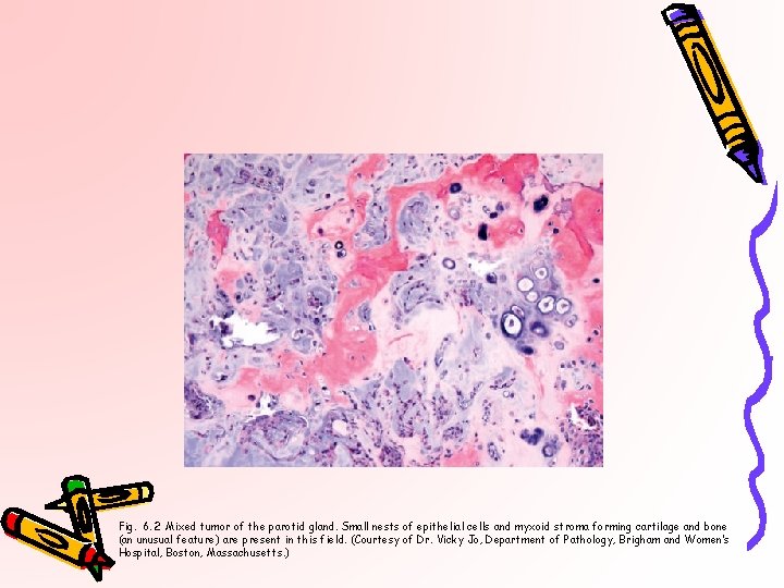 Fig. 6. 2 Mixed tumor of the parotid gland. Small nests of epithelial cells