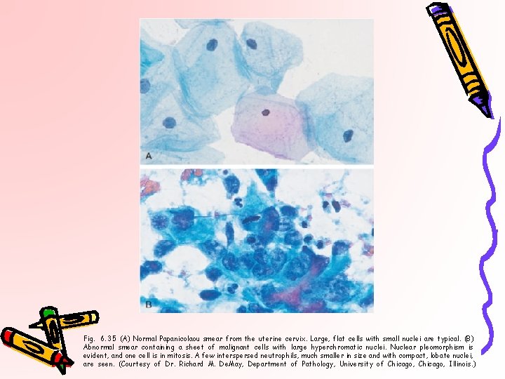 Fig. 6. 35 (A) Normal Papanicolaou smear from the uterine cervix. Large, flat cells