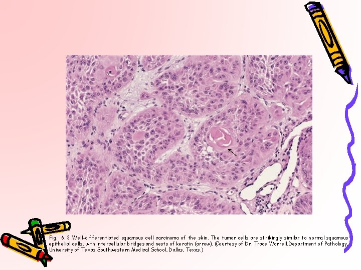 ← Fig. 6. 3 Well-differentiated squamous cell carcinoma of the skin. The tumor cells