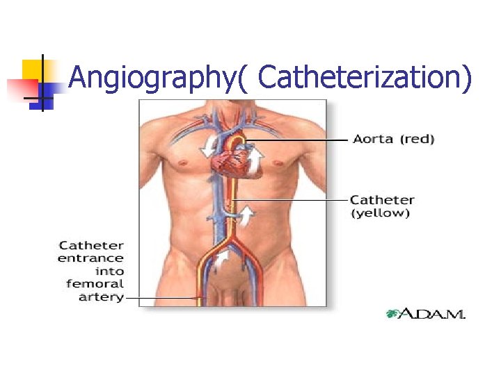 Angiography( Catheterization) 