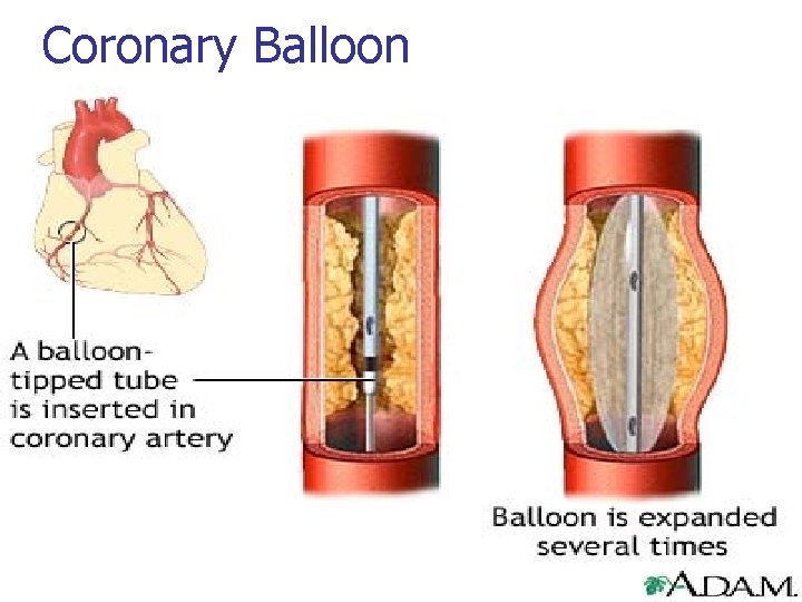 Coronary Balloon 
